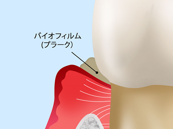 虫歯になる原因の理解から