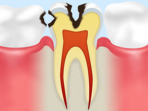 [C2]象牙質の虫歯
