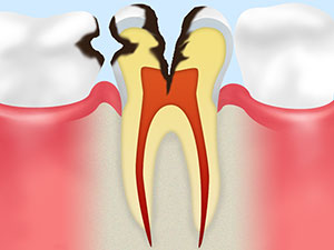 [C3]神経に達した虫歯