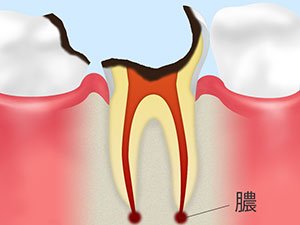 [C4]歯の根に達した虫歯