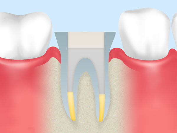 歯を残す根管治療とは