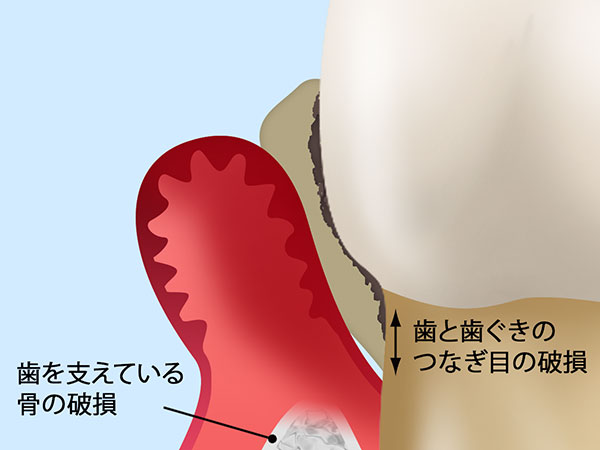 日本人が歯を失う原因の第一位は歯周病